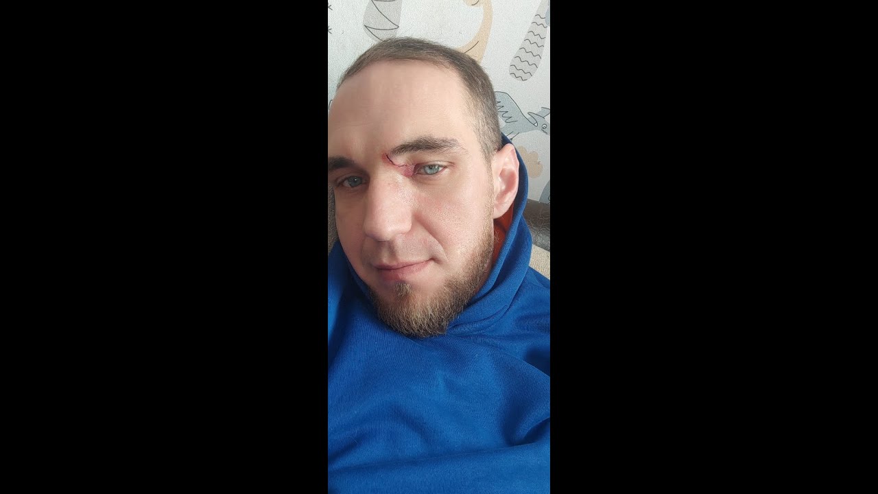 после дтп только расичение слава Богу 🙏