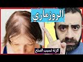 تحذير هام اياك استخدام الروزماري او اكليل الجبل بهذه الطريقة المنتشرة لعلاج الصلع و تساقط الشعر