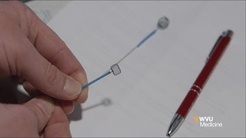 Aneurysm Treatment with the Woven Endobridge (WEB) Device