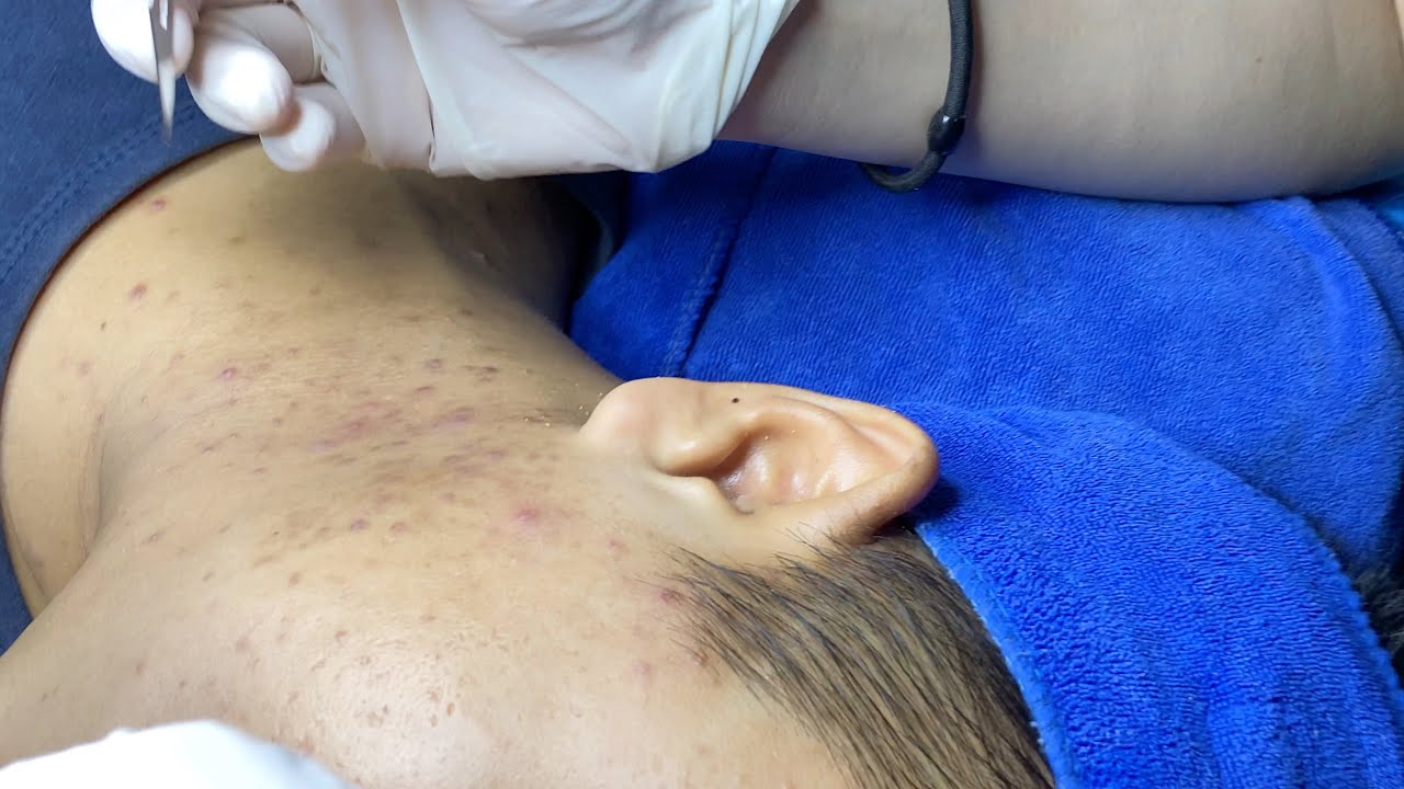 Acne Around Neck And Jaw | Mụn Quanh Cổ Và Quai Hàm  - SacDepSpa#260