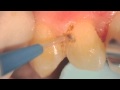 Post-Ortho Gingivectomy with a Picasso Laser