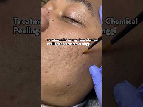 PEELING SUPER GLOW MP SKIN CARE BLITAR | MENGHILANGKAN FLEK HITAM