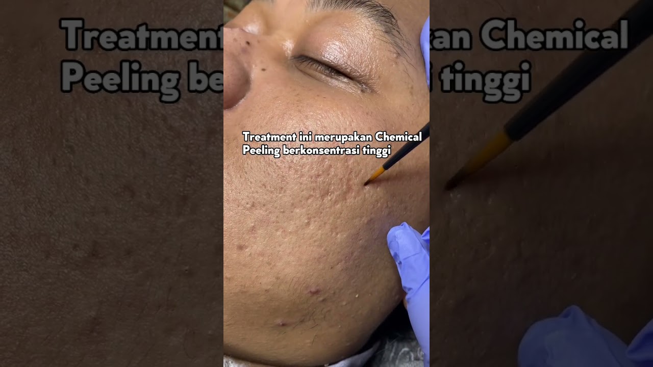 Yang punya bopeng, wajib cobain treatment ini😭