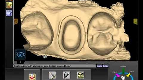 E4D Cerec computer design of a porcelain crown