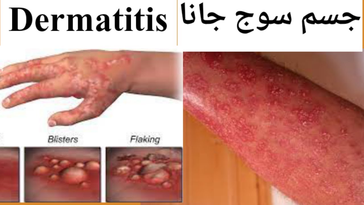 Dermatitis, Causes, Symptoms, Diagnose, Medicine, Treatment for