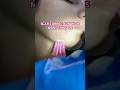 MONO THREAD SCAR TREATMENT #song #bollywood #dance #challenge #scar #treatment #delhi #collagen