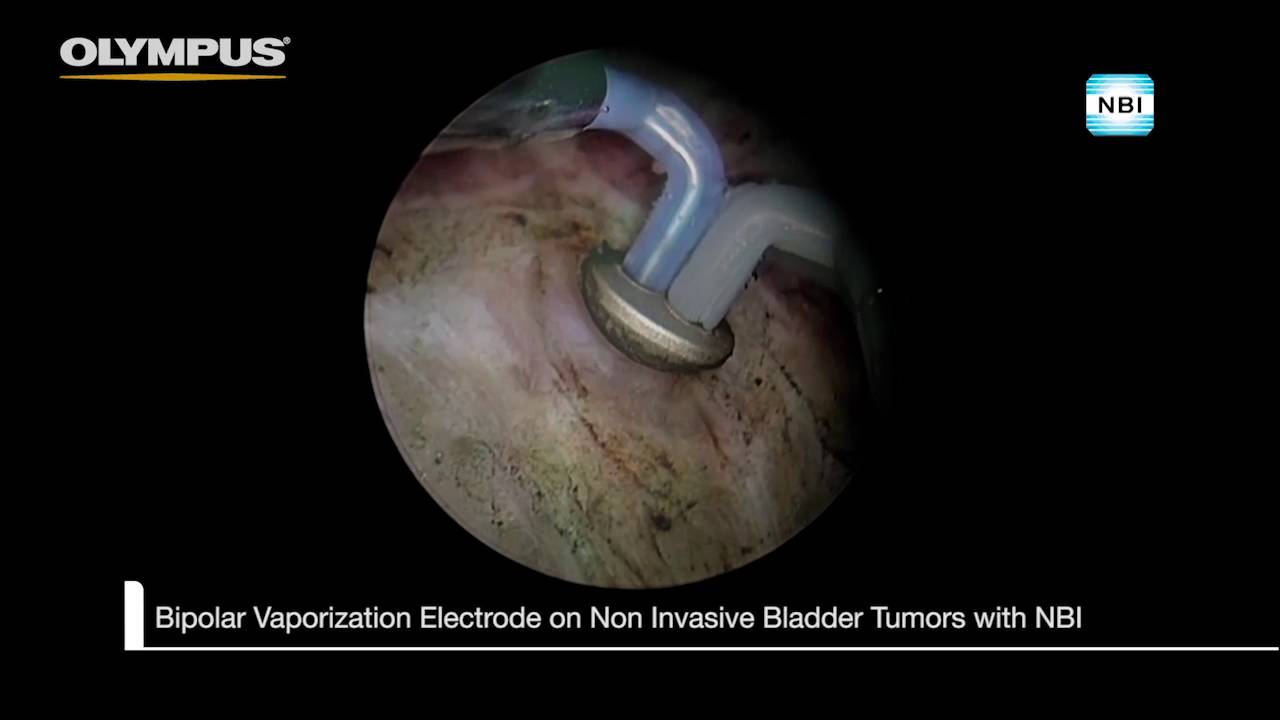 Narrow Band Imaging YouTube Narrow Band Imaging YouTube