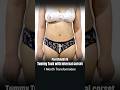 Loose Skin After Weight Loss? Tummy Tuck with Internal Corset Result
