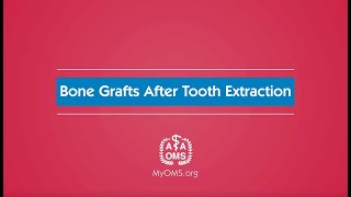 Bone Grafts After Tooth Extraction