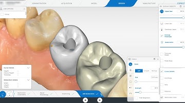 Cerec Primescan Implant Crown Design