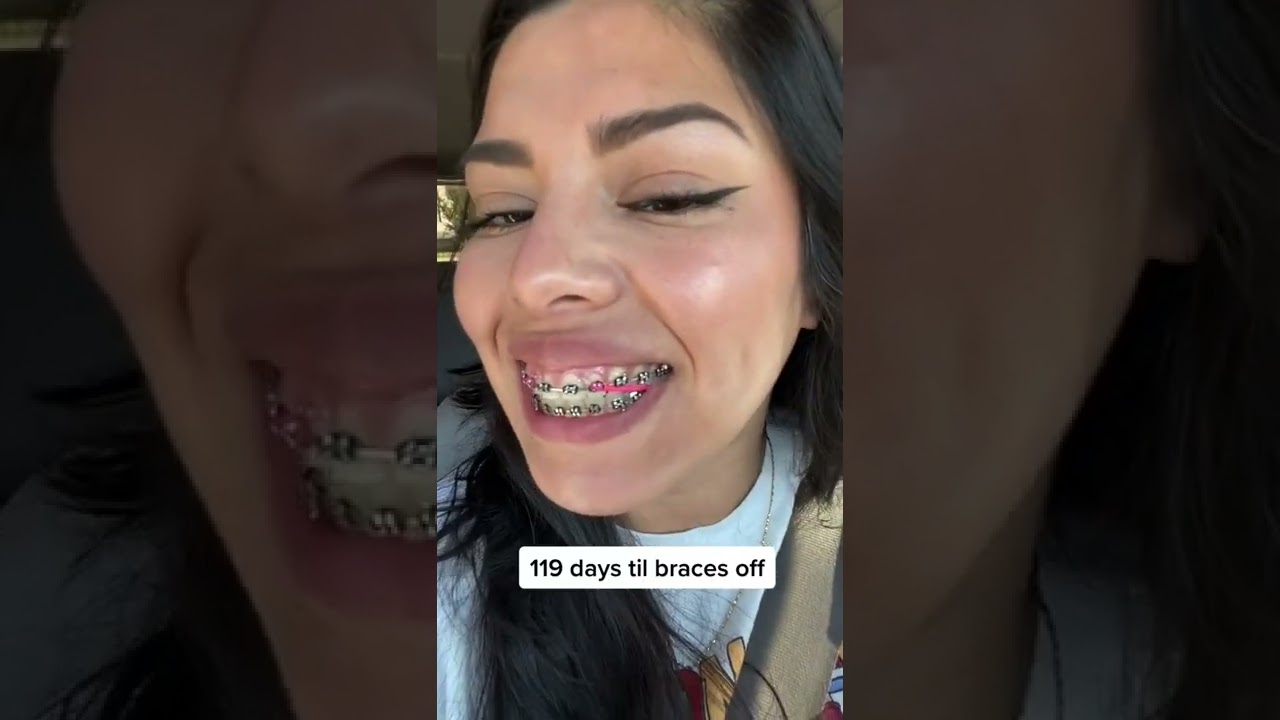 My teeth before braces tiktok RubyNC YouTube