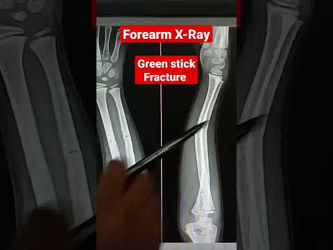 Video: Bolí zlomenina greenstick?