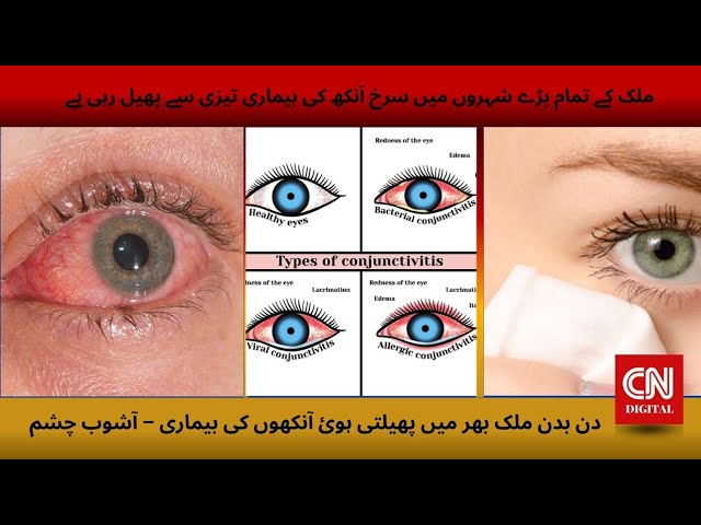 Red eye disease is spreading rapidly in all major cities of the country