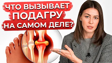 Это разрушает ваши суставы! / Что НЕЛЬЗЯ есть при подагре?