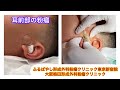 耳前部の粉瘤　ブログでも粉瘤について詳しく解説してます。東京皮膚のできものと粉瘤クリニック　ふるばやし形成外科新宿院　大阪梅田形成外科クリニック