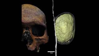 TUMORES CEREBRALES EN LA ANTIGUA ROMA #curiosidades #historiaoculta #arqueología #aprendeentiktok