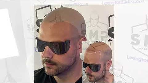 Healed Scalp Micropigmentation (SMP)