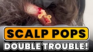 SCALP POPS - DOUBLE TROUBLE!