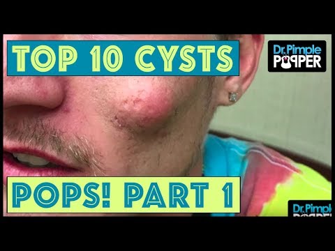 Dr Pimple Popper's Top 10 Cyst POPS Of 2017,  Part 1!