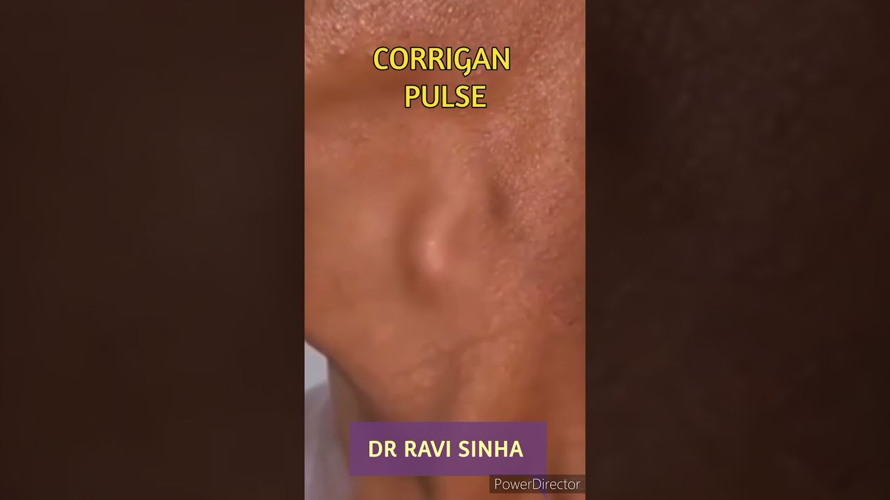DANCING CAROTID OR CORRIGAN,S PULSE      Dr Ravi Sinha