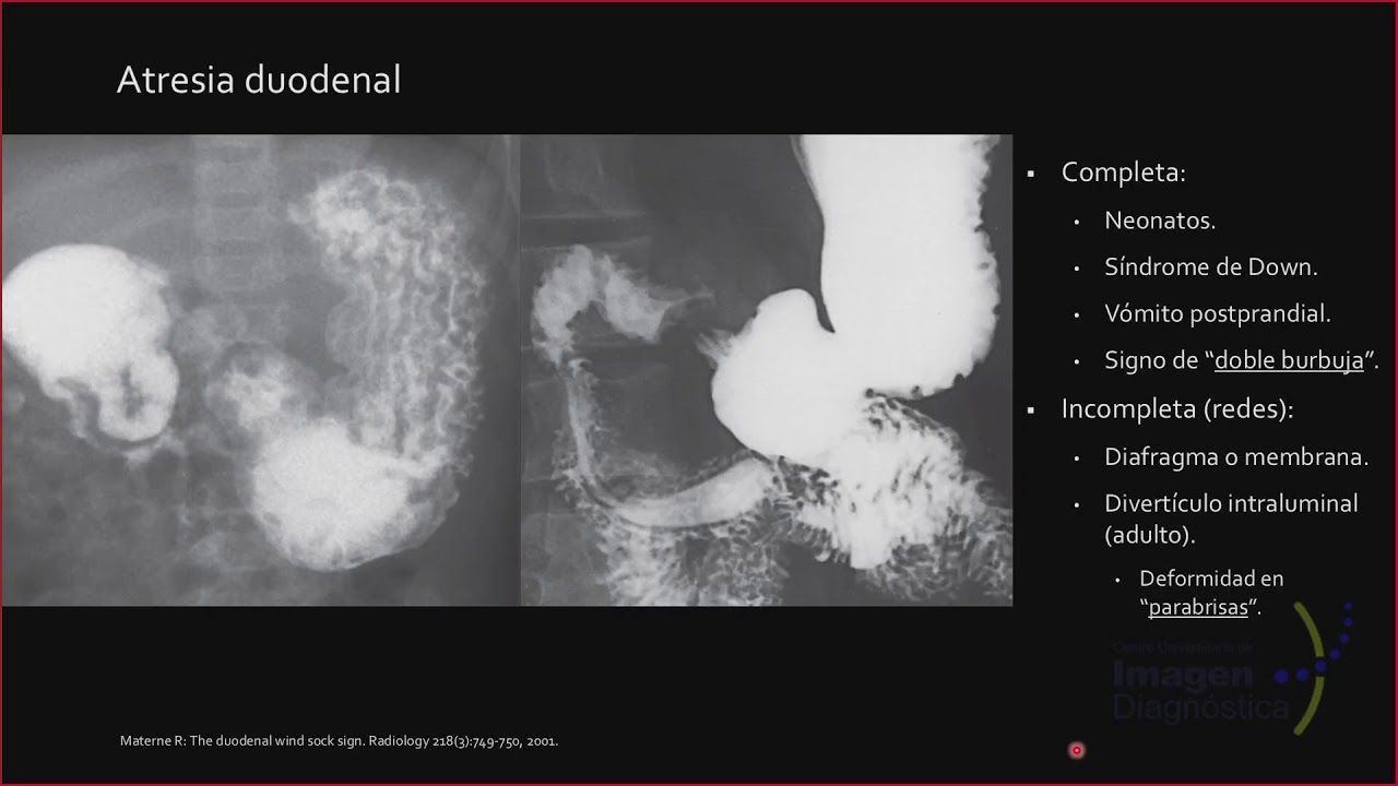Anatomía radiológica del estómago y patología benigna. Dr. Mario