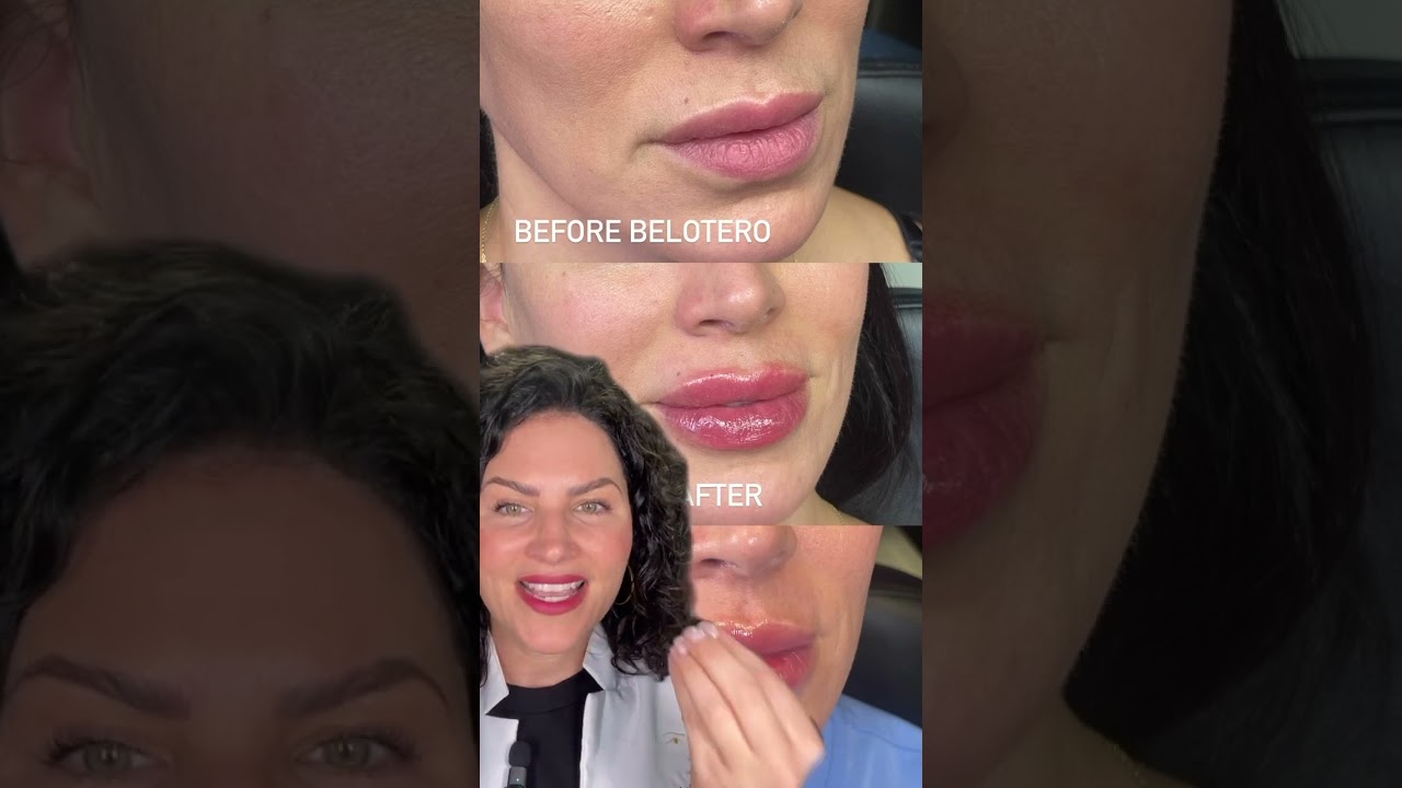 Belotero Lip Filler Before & After