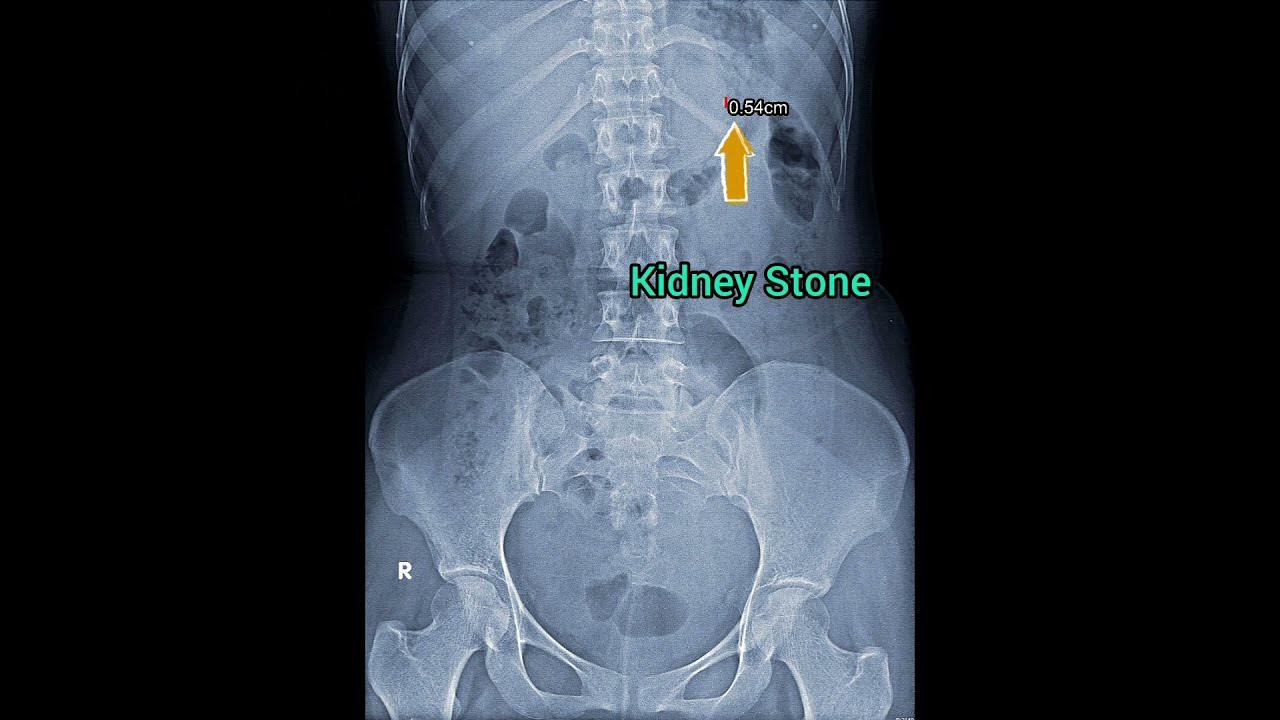 kidney stones gabapentin