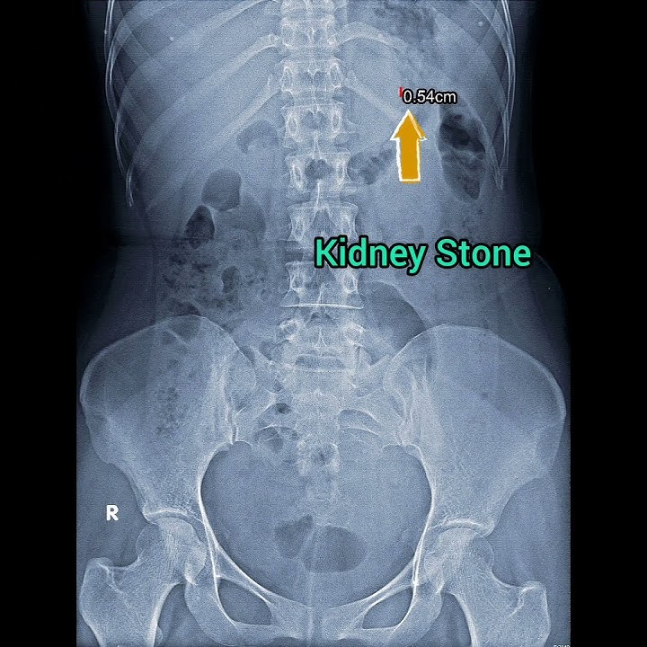 Kidney Stone In KUB X ray #shortsvideo