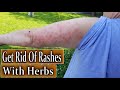 Foraging Wild Plants To Get Rid Of Rashes, Making Skin Wash For Rashes