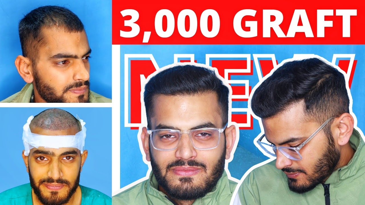 This 3000 Grafts Hair Transplant Result is A Masterpiece !!! Hair Transplant Cost In India 2024