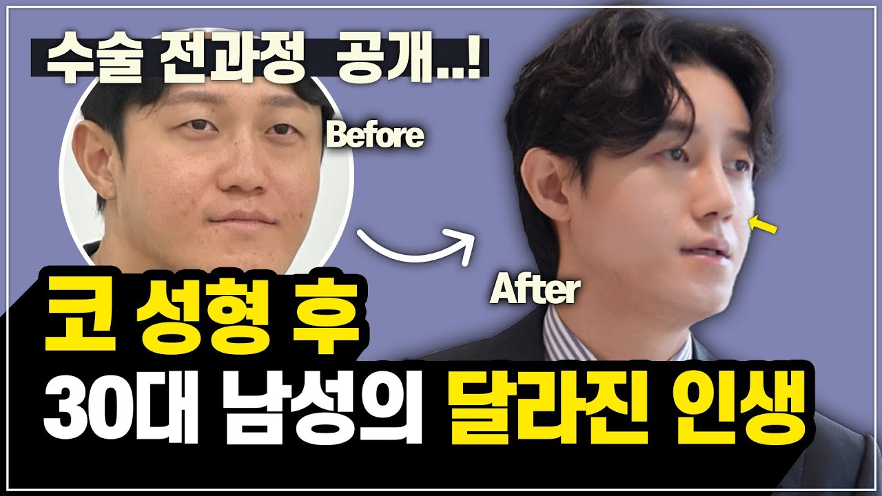 코 성형의 정석, 이마 광대 지방이식까지 수술 전 과정을 공개합니다..! - YouTube