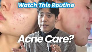At-Home Pimple and Acne Treatment: 3 Ultimate Ways to Clear Skin (No Tretinoin / No Accutane)