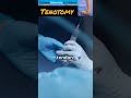 Tenotomy Surgical Procedure #Tenotomy #SurgicalProcedure
