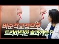 코수술로 비순각을 교정하면 드라마틱한 예쁜코를 가질수있다고?