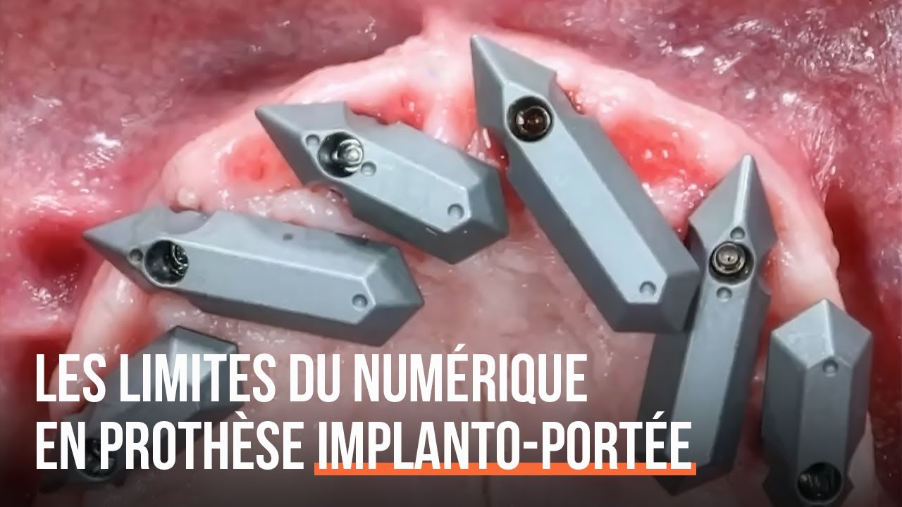 Les limites du numérique en prothèse implanto-portée complète fixe - Dr Mai Lan Tran