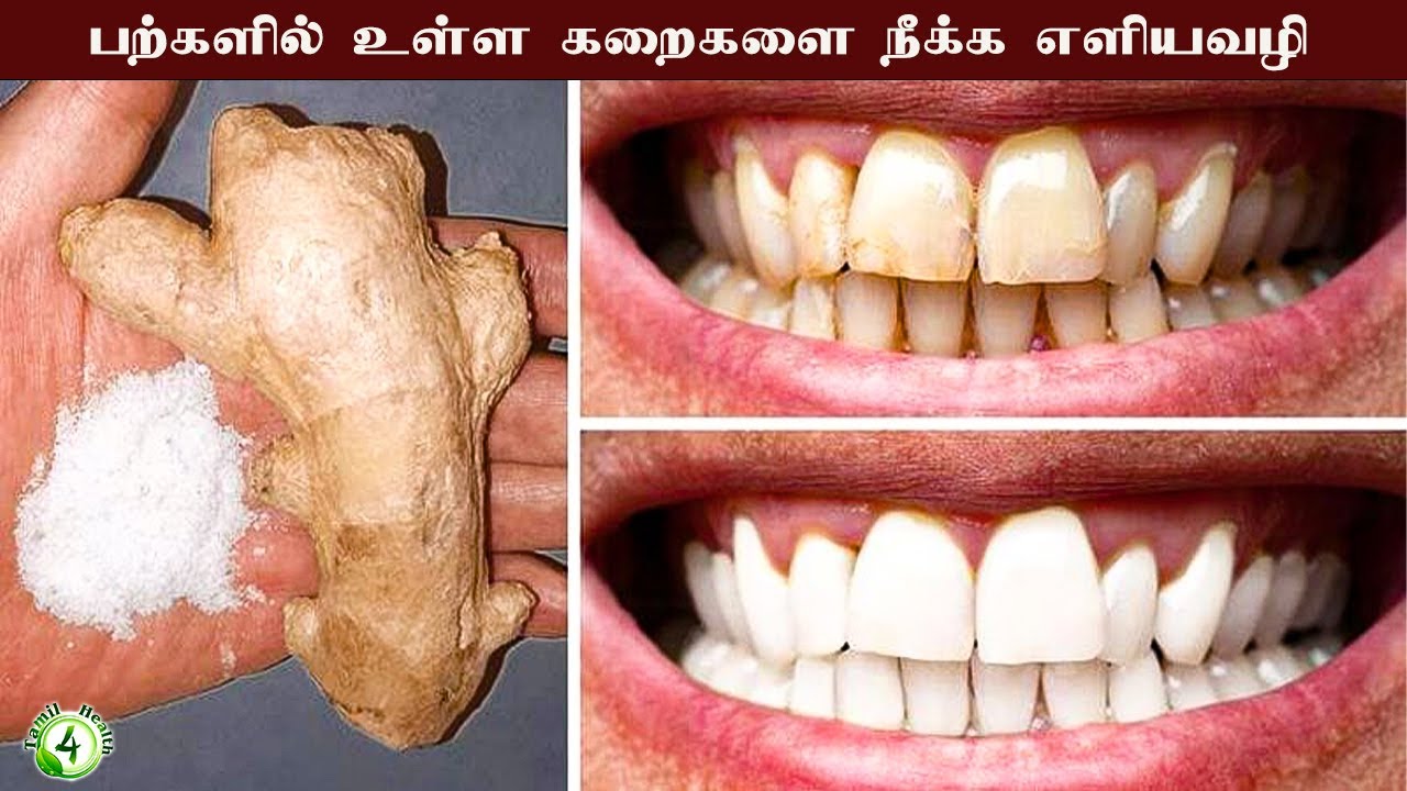 பற்களில் உள்ள கறைகளை நீக்குவது எப்படி? |  Home treatment for teeth whitening