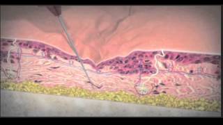 Juvederm Voluma Animation