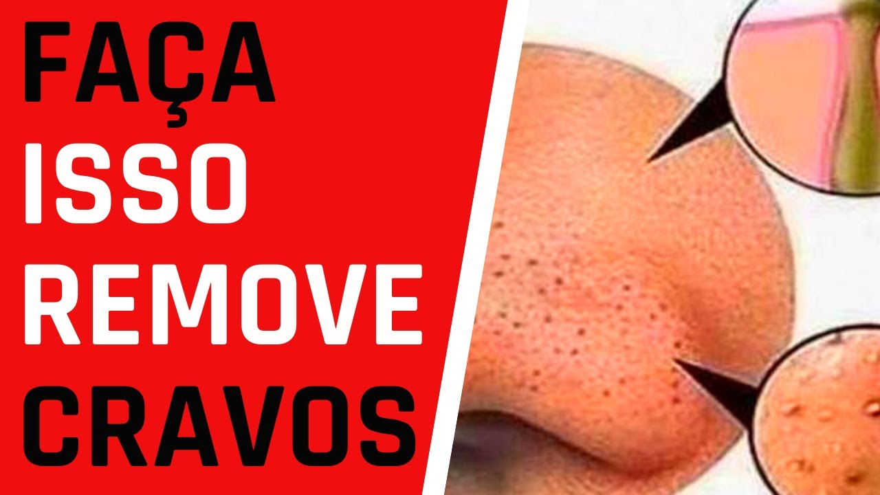 REMOVER CRAVOS -Removendo Cravos do Nariz Como Tirar Cravos COM ESSA ...