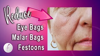How to Reduce Malar Bags Eye Bags and Festoons