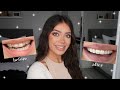 MY TEETH JOURNEY Q&A | Invisalign & Composite Bonding