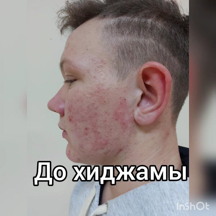 Хиджама от угрей на спине и лице - YouTube