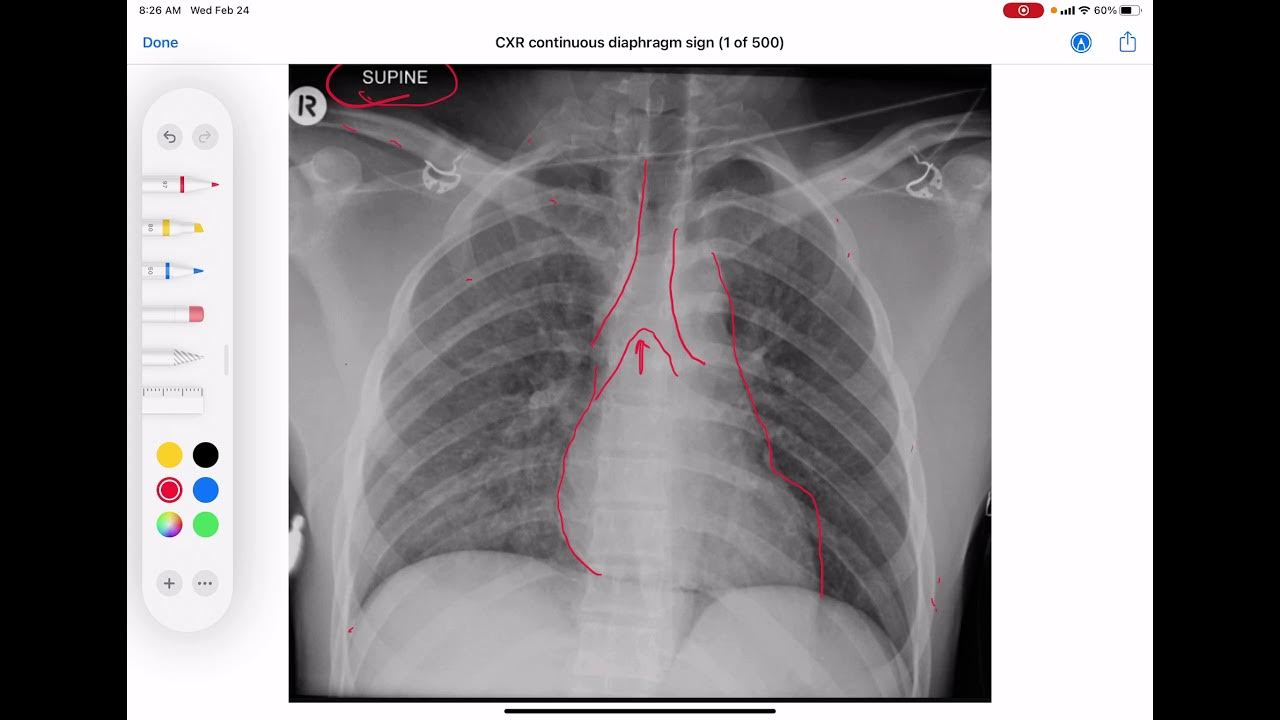 CXR Continuous diaphragm sign YouTube