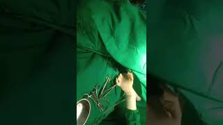 C-section delivery baby - Transverse lie position