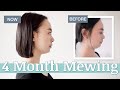 4 Months Mewing Before & After at Age 28