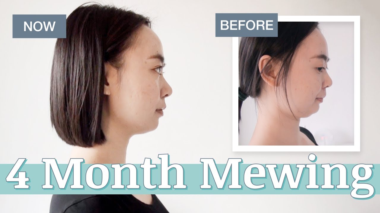 8 MONTH MEWING TRANSFORMATION VIDEO  19 YEARS OLD BEFORE AND AFTER 