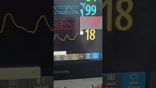 How to measure PPV II Pulse Pressure Variation #intensivecare #criticalcare #anaesthesiology #icu