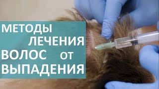 Трихолог о выпадении волос. 💇 Врач - трихолог расскажет о методах лечения выпадения волос.