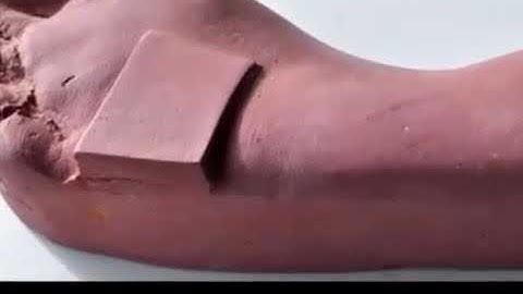 Capture Forefoot Valgus and Varus in Foam box cast