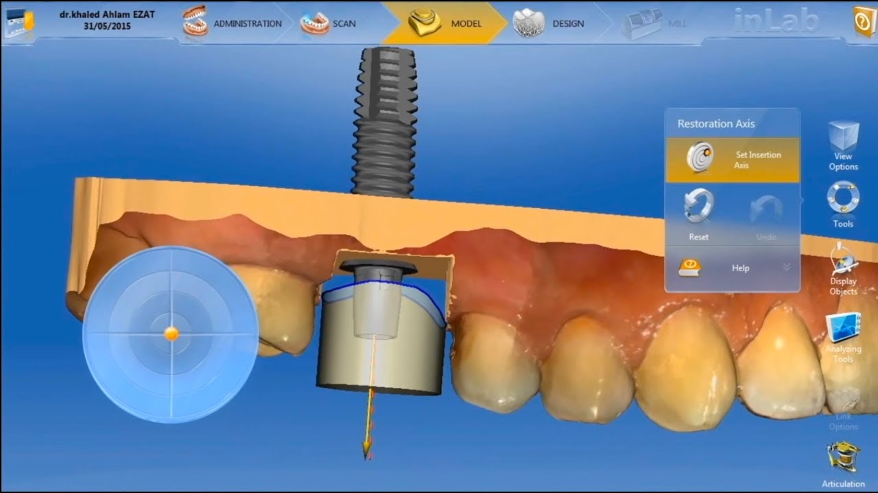 How to restore dental implant in one visit, using TiBase (Digital