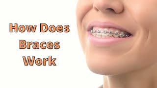 Did You Know How Dental Braces Work |  Orthodontic Treatment screenshot 5